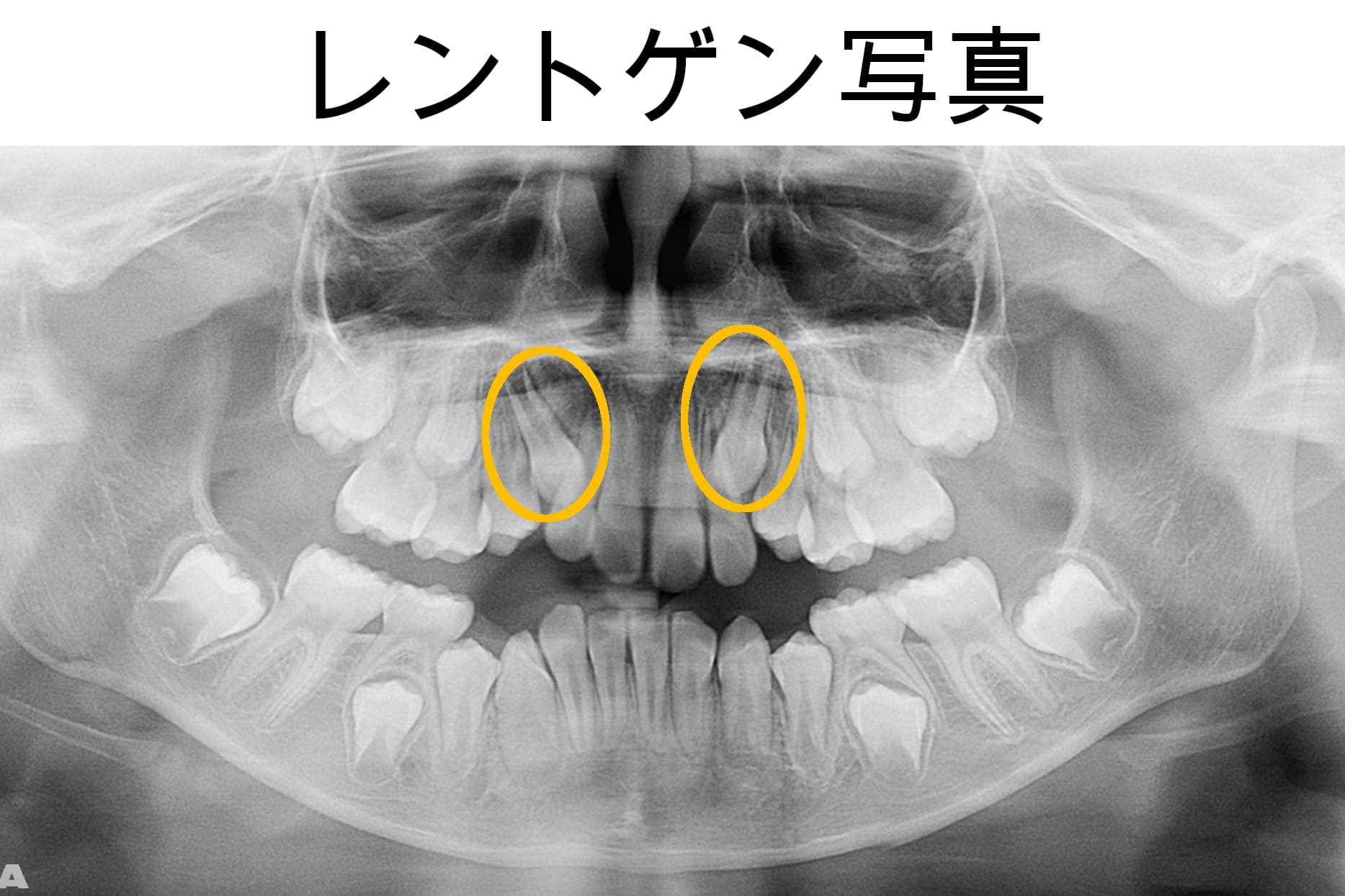 矯正後の写真